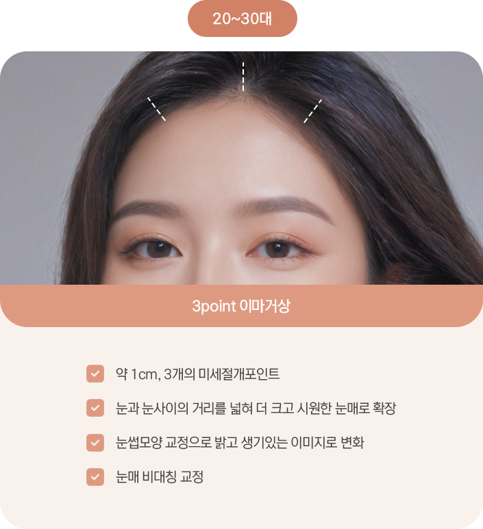 내시경 이마거상 미세절개 포인트 — 눈과 눈 사이의 거리를 넓혀 더 크고 시원한 눈매로, 눈썹 모양 교정으로 밝고 생기 있는 이미지로 변화, 눈매 비대칭 교정