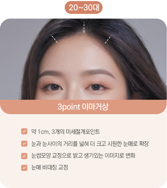 내시경 이마거상 미세절개 포인트 — 눈과 눈 사이의 거리를 넓혀 더 크고 시원한 눈매로, 눈썹 모양 교정으로 밝고 생기 있는 이미지로 변화, 눈매 비대칭 교정