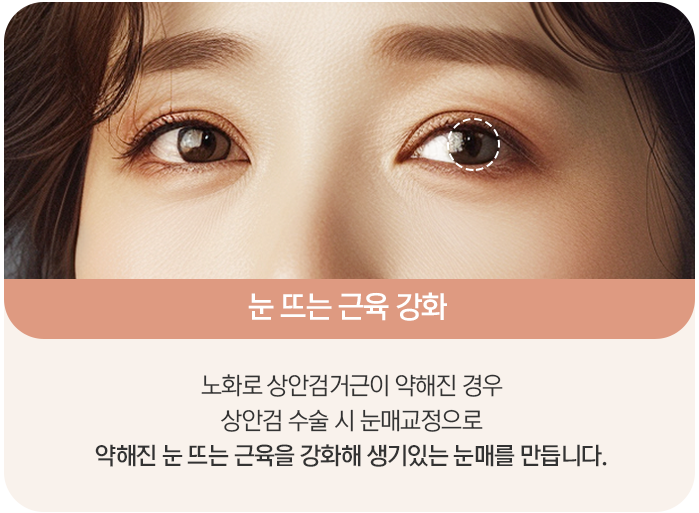 상안검 수술 시 눈매교정 설명 그림