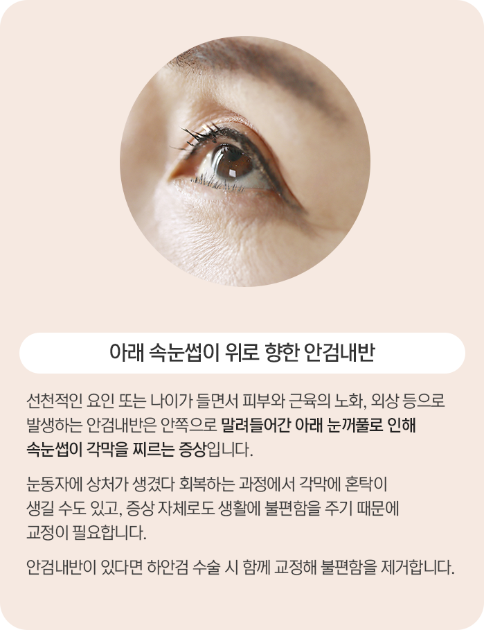 안검내반 설명 — 아래 속눈썹이 위로 향한 안검내반은 선천적인 요인 또는 나이가 들면서 피부와 근육의 노화, 외상 등으로 발생합니다. 안쪽으로 말려들어간 아래 눈꺼풀로 인해 속눈썹이 각막을 찌르는 증상으로, 회복 과정에서 각막에 혼탁이 생길 수도 있고 생활에 불편함을 주기 때문에 교정이 필요합니다. 안검내반이 있다면 하안검 수술 시 함께 교정합니다.