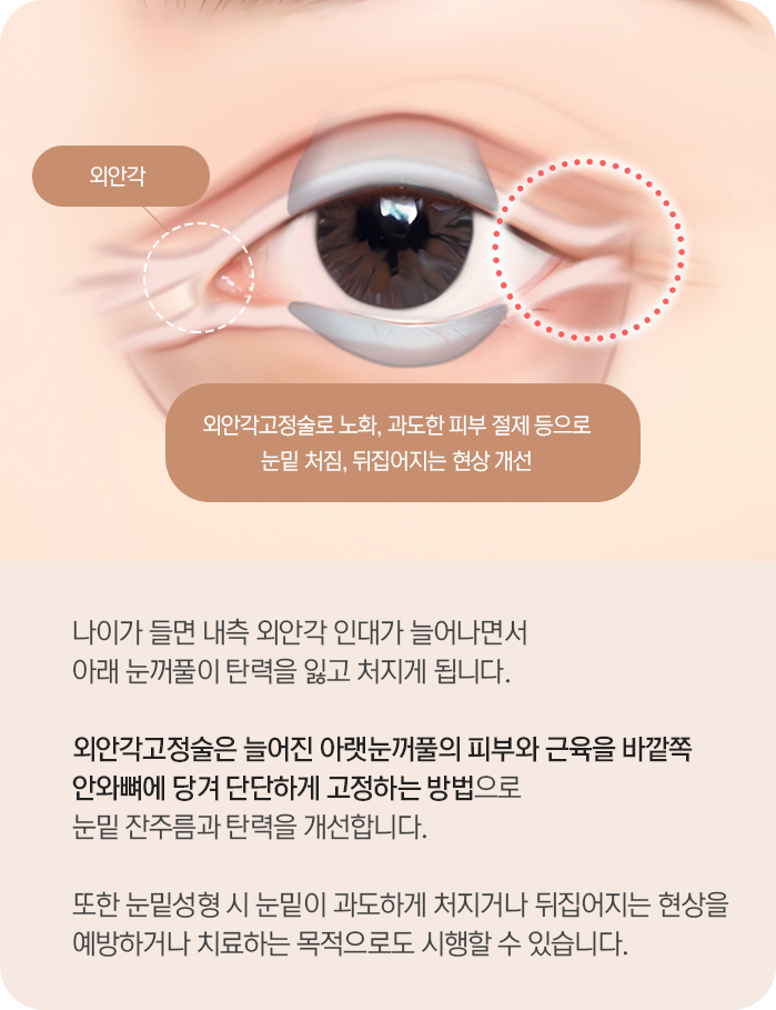 외안각고정술 설명 — 나이가 들면 내측 외안각 인대가 늘어나면서 아래 눈꺼풀이 탄력을 잃고 처지게 됩니다. 외안각고정술은 늘어진 아랫눈꺼풀의 피부와 근육을 바깥쪽 안와뼈에 당겨 단단하게 고정하는 방법으로 눈밑 잔주름과 탄력을 개선합니다. 눈밑성형 시 눈밑이 과도하게 처지거나 뒤집어지는 현상을 예방하거나 치료하는 목적으로도 시행할 수 있습니다.