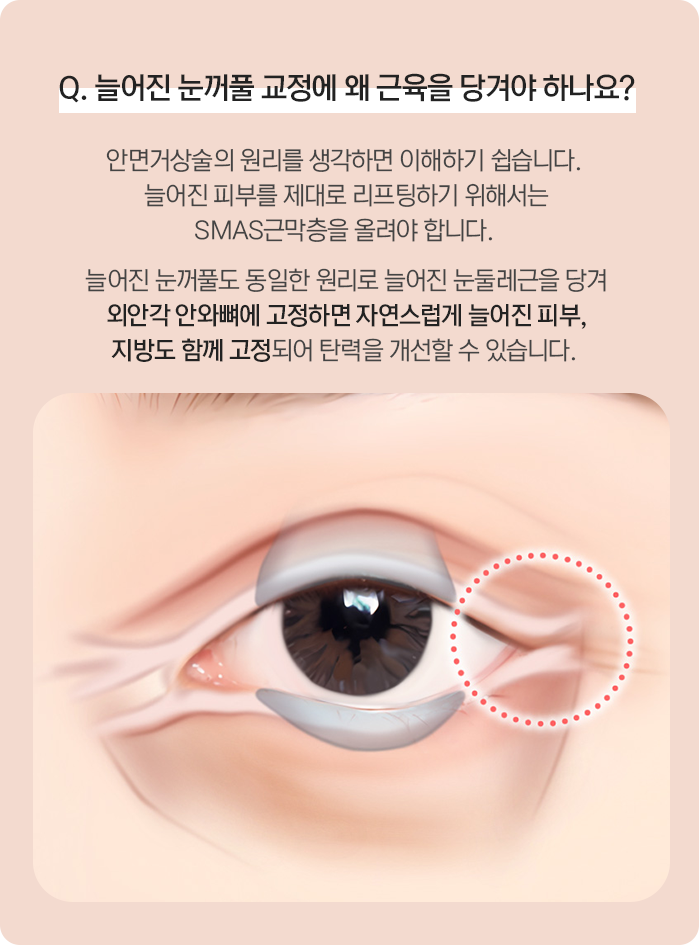 늘어진 눈꺼풀 교정에 왜 근육을 당겨야 하나요 — 늘어진 눈둘레근을 당겨 외안각 안와뼈에 고정하면 탄력을 개선할 수 있습니다.