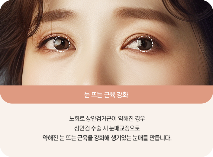 상안검 수술 시 눈매교정 설명 그림