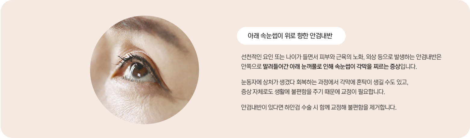 안검내반 설명 — 아래 속눈썹이 위로 향한 안검내반은 선천적인 요인 또는 나이가 들면서 피부와 근육의 노화, 외상 등으로 발생합니다. 안쪽으로 말려들어간 아래 눈꺼풀로 인해 속눈썹이 각막을 찌르는 증상으로, 회복 과정에서 각막에 혼탁이 생길 수도 있고 생활에 불편함을 주기 때문에 교정이 필요합니다. 안검내반이 있다면 하안검 수술 시 함께 교정합니다.