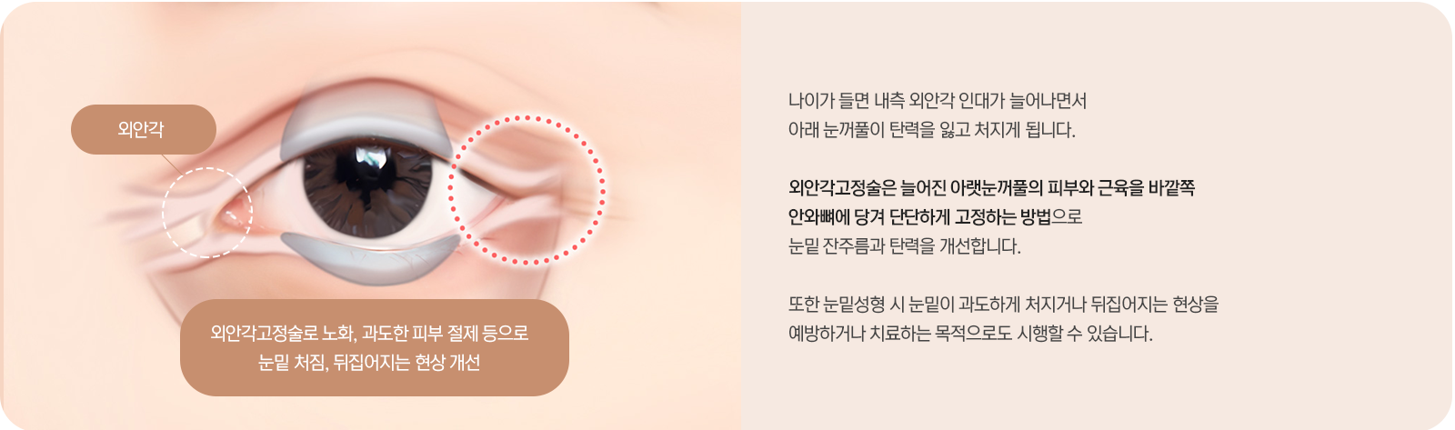 외안각고정술 설명 — 나이가 들면 내측 외안각 인대가 늘어나면서 아래 눈꺼풀이 탄력을 잃고 처지게 됩니다. 외안각고정술은 늘어진 아랫눈꺼풀의 피부와 근육을 바깥쪽 안와뼈에 당겨 단단하게 고정하는 방법으로 눈밑 잔주름과 탄력을 개선합니다. 눈밑성형 시 눈밑이 과도하게 처지거나 뒤집어지는 현상을 예방하거나 치료하는 목적으로도 시행할 수 있습니다.
