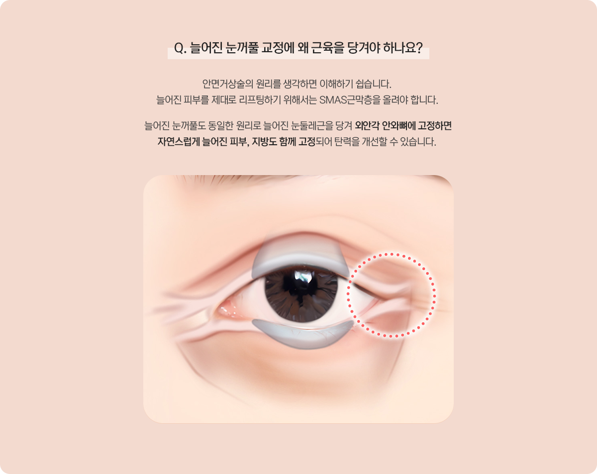 늘어진 눈꺼풀 교정에 왜 근육을 당겨야 하나요 — 늘어진 눈둘레근을 당겨 외안각 안와뼈에 고정하면 탄력을 개선할 수 있습니다.